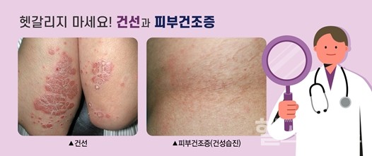 ‘건조증’과‘건선’비교사진(제공:강동경희대병원)