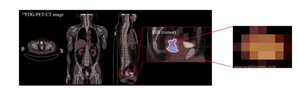 직장암환자PET영상예측모델개요