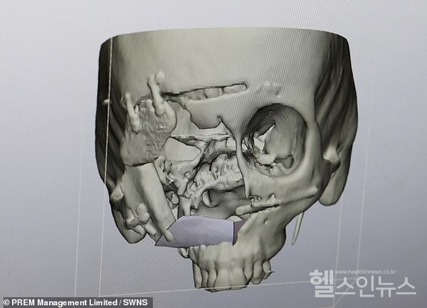 데일리메일제공,얼굴(사진)의3D모델은의료진이종양의범위를더잘이해하고수술후재건하는데도움을줄수있다.