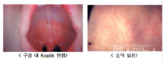 사진출처:미국질병관리본부(CentersforDiseaseControlandPrevention)