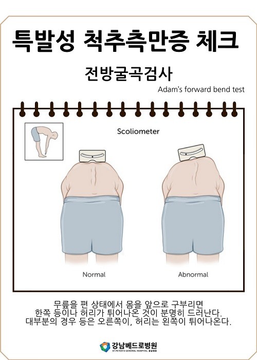 소아척추측만증검사할수있는전방굴곡검사