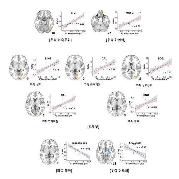 기능적MRI와뇌파검사결과우측하측두회,우측안와회및일부후두부에서모두유의미한양의상관관계를보였다(노란색/빨간선).좌측해마와우측편도체에서는두검사결과사이의음의상관관계를보였다(파란색)