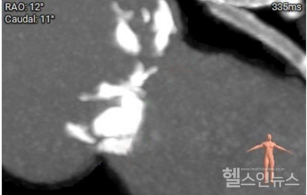 타비시술전이모씨의심장CT사진.대동맥판막에심한석회화(흰색음영)가관찰되며,석회화가좌심실유출로(붉은색화살표)까지침범함.