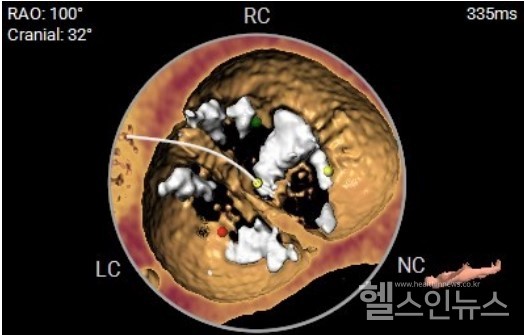 이모씨의심장CT를재구성한대동맥판막사진.소엽이2개뿐인이엽성대동맥판막이며심한석회화(흰색음영)가진행돼있음.
