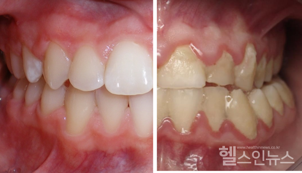 (왼쪽부터)깨끗하고건강한입안과치태/플라그가많이쌓인입안