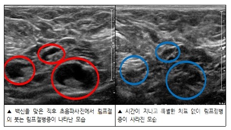 코로나19백신접종후시간에따른림프절병증변화모습
