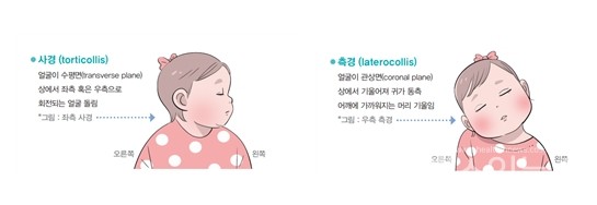 (왼쪽부터)'사경'과‘측경’(출처:중앙대병원‘기운목재활치료운동방법’)