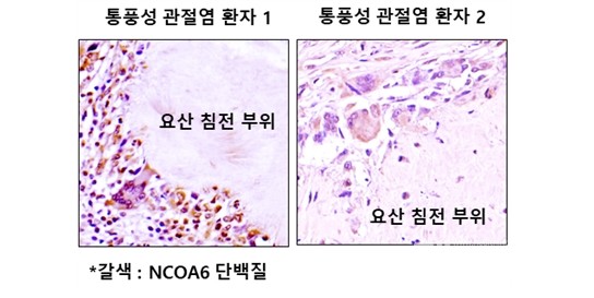통풍성관절염환자의병변부위에핵수용체활성보조인자6(Nuclearreceptorcoactivator,NCOA6)의발현이증가되어있음.
