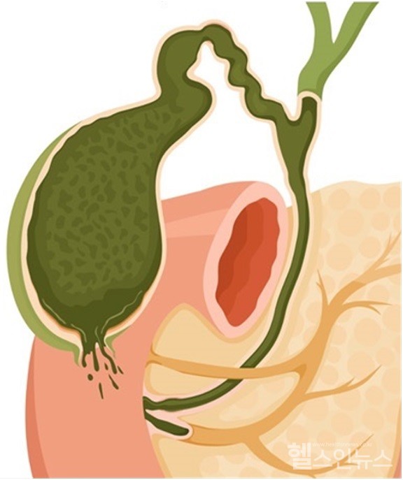 무결석성담낭염에서담낭천공이발생한모습