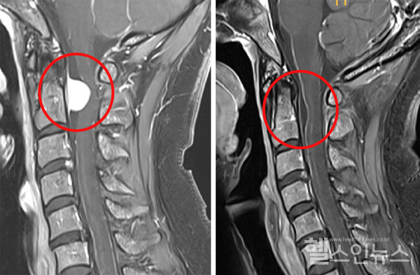 (좌측)수술전상부경추신경전방에위치한종양,(우측)수술후완벽히제거된종양
