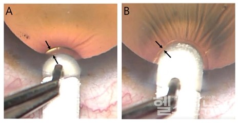 망막반사를이용한앞부분층각막이식수술장면