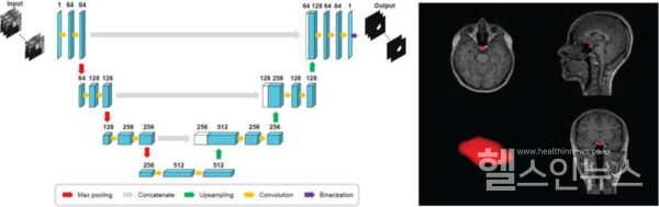 뇌하수체자동분할딥러닝모델(좌측)및자동분할결과