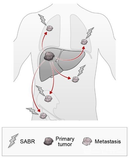수전이성간암에시행하는체부정위적방사선치료원리