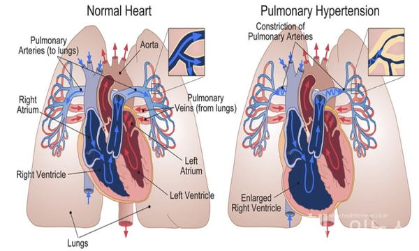 출처:NEnglJMed.2021;385(25):2361-2376