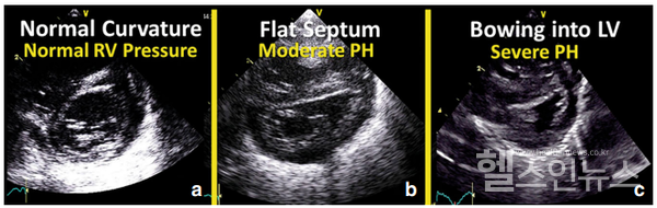 출처:PediatricResearch,2018;84:S68-S77