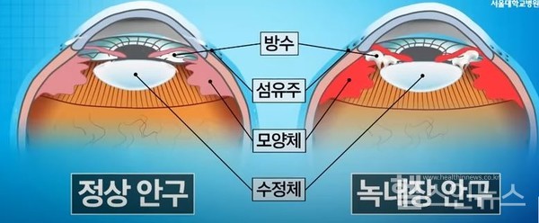 정상안구와녹내장안구의비교