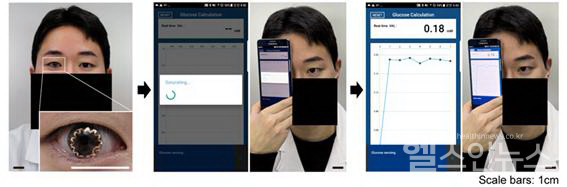 연구진이스마트콘택트렌즈를착용후혈당을재고있다.