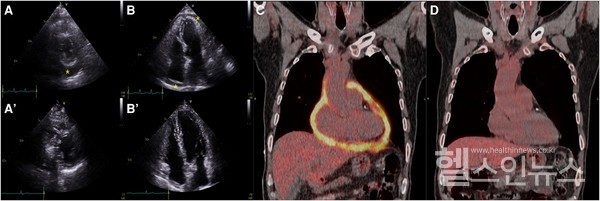 치료전밝게빛나던심낭이치료후인근부위와유사한음영을보이고있다.