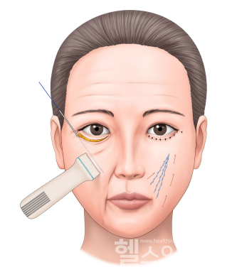 초음파와실리프팅을이용한하안검수술및중안면거상의모식도