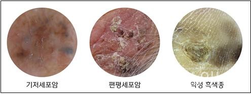 피부암종류,가톨릭대인천성모병원제공