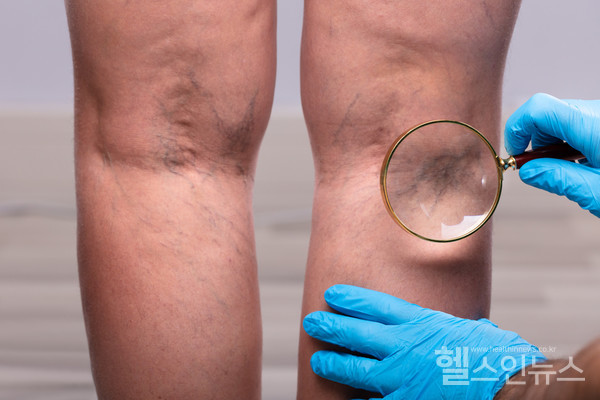 하지정맥류이미지(출처:클립아트코리아)