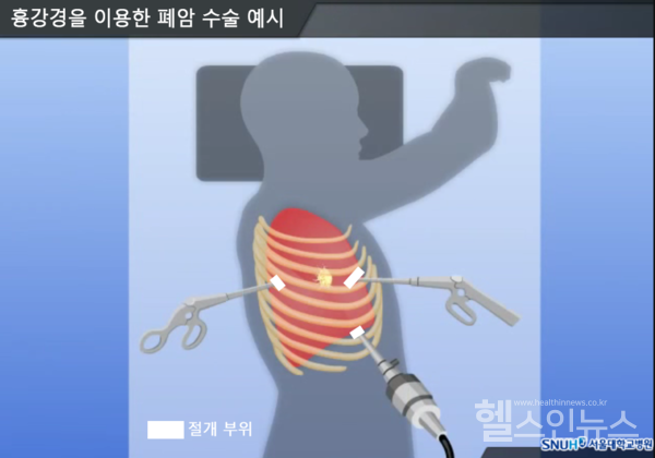 흉강경을이용한페암수술예시(출처:서울대병원)