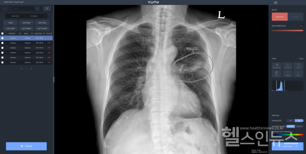 이동형엑스레이장비에탑재되는뷰노메드체스트엑스레이™운영화면예시