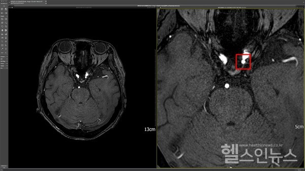 DEEP:NEURO(딥뉴로)판독이미지