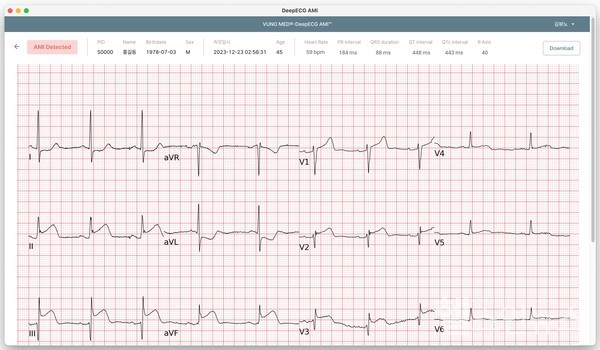 VUNOMed®-DeepECG™AMI운영화면예시
