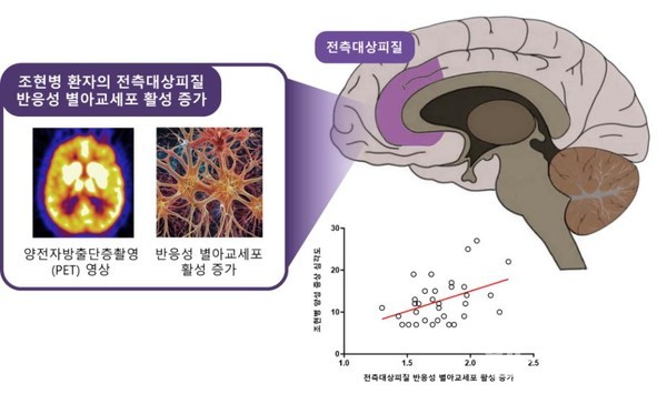 조현병환자의뇌속전측대상피질에서반응성별아교세포(뇌염증반응및글루타메이트조절이상시사)의활성증가를확인했다.또한,조현병환자에서전측대상피질의반응성별아교세포활성이증가할수록환청,망상등조현병의양성증상이심각하다는것을확인했다.