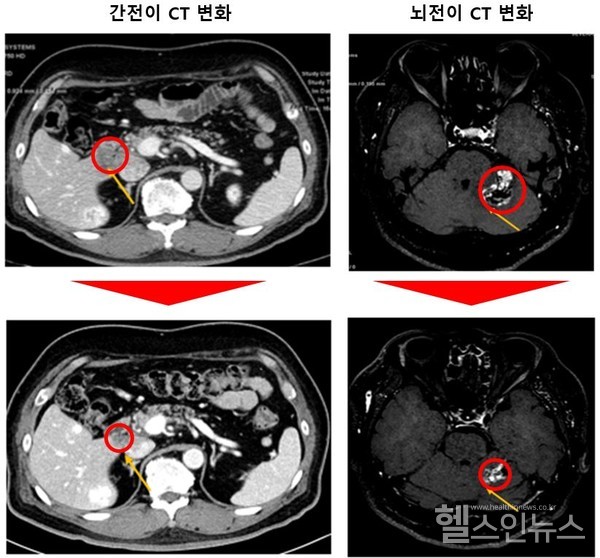간과뇌에암이전이된환자의간과뇌종양크기가각각감소한모습,암병변은87%정도감소했고18개월이상반응을유지중이다