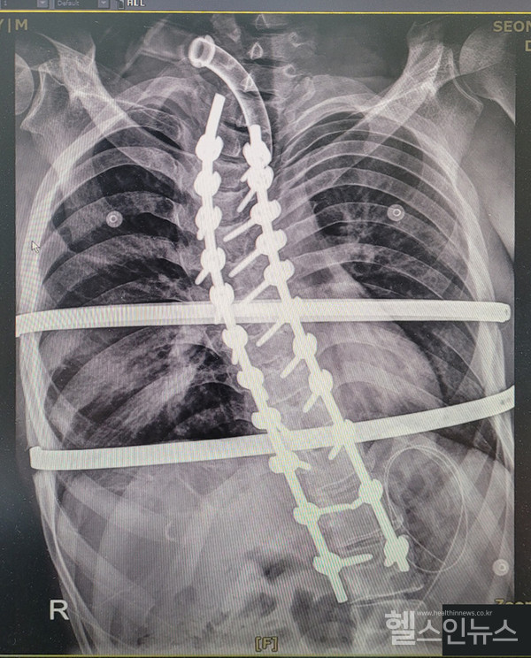 선천성중증뇌성마비환자인이성한(가명ㆍ31세)씨가서울특별시서남병원에서심한척추측만증에대한교정수술을받은후정면엑스레이사진