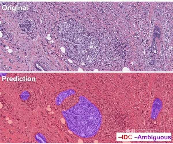 딥바이오-MurSS모델의시각화결과:침윤성유관암은빨간색,모호한영역은보라색으로구분해처리했다.