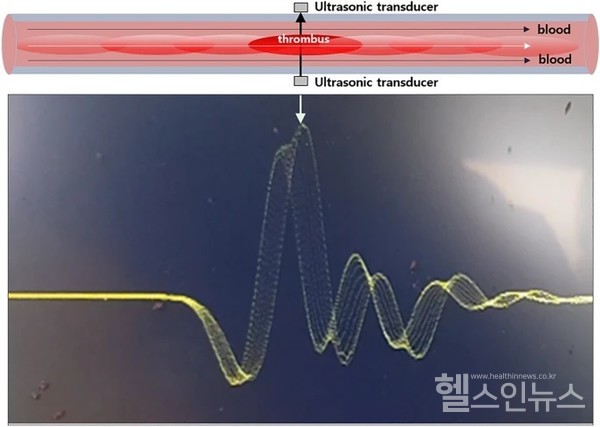 혈전으로인한초음파파동의변화
