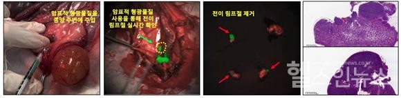 암표적형광물질을이용한전이림프절확인및제거모습