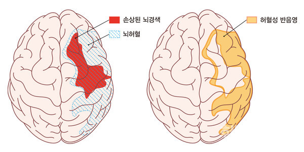 ▷붉은색부위–손상된뇌경색중심부,▷파란빗금부위-뇌경색중심부포함뇌허혈부위▷노란색부위–급성기치료의중심허혈성반음영부위