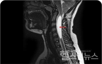 척추공동증환자의엑스레이사진(제공:강남베드로병원)