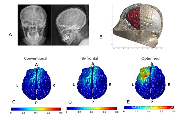 A티타늄임플란트뇌수술을받은최소의식상태진단환자의엑스레이BtDCS치료를위한시뮬레이션영상C기존방법을이용하여치료한최소의식상태환자의뇌로,뇌기능이대부분비활성화되어있음.D머리좌우양측에tDCS치료를시행한결과기존치료보다는활성화된것을확인했다.E환자의MRI를기반으로최적화를통한tDCS치료시뇌기능이월등히활발해짐을알수있다.