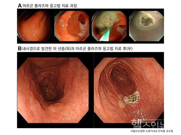 아르곤플라즈마응고법으로위선종을치료하는과정