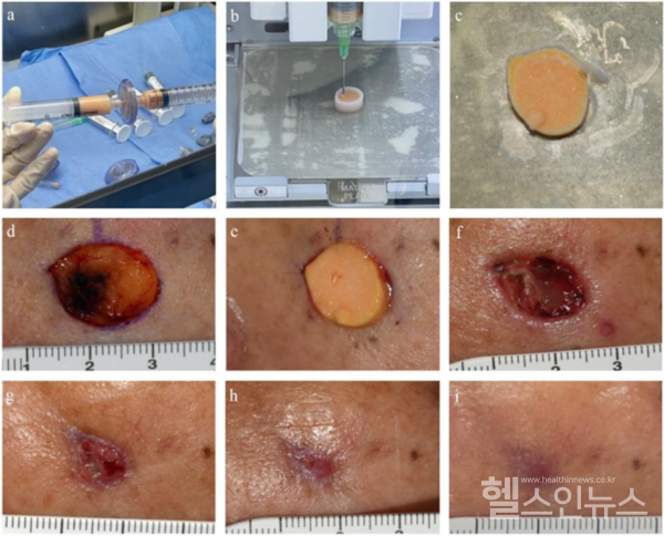 3D프린팅된미세화지방조직(MAT)치료과정(a)채취한지방조직은칼날모양의micro-meshdiscs를통과하는미세화과정을거침(b)MAT는디스펜서2를사용해환부크기에맞는PCLScaffold에출력(c)3D프린팅된MAT(d)종양절제후(e)MAT이식직후(f)1주후(g)3주후(h)4주후환부관찰(i)환부는5주후에완전히치유됨