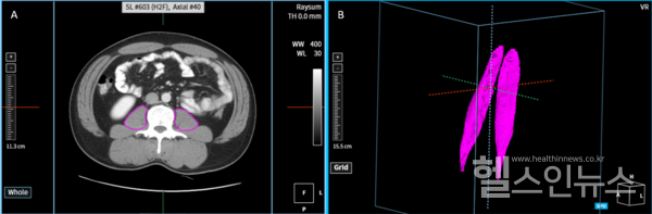 CT데이터에서인공지능으로추정된요근형태