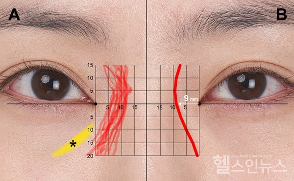 붉은선이코옆과눈안쪽구석사이를지나가는눈구석동맥이분포되어있는곳으로노란색은눈안쪽눈물고랑이다.안쪽눈구석에서그은수직선안쪽으로는눈동맥과연결된눈구석동맥이분포해필러시술시각별한주의가필요하다.