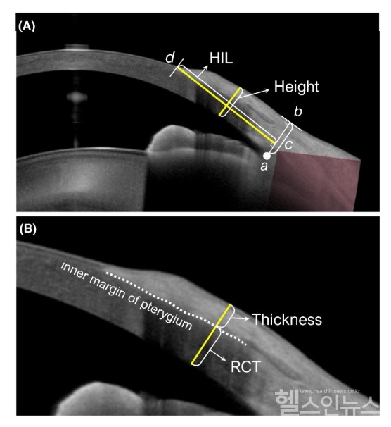 (A)익상편의수평각막침범길이,(B)익상편두께(출처:김경우교수연구팀논문)