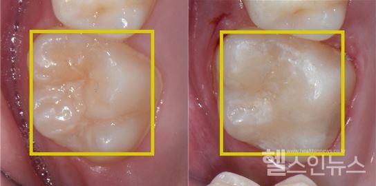 어금니치면열구실란트치료전(왼쪽)후(오른쪽)모습