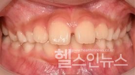 윗앞니사이가벌어져있는모습