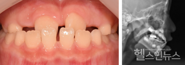 반대교합의사례