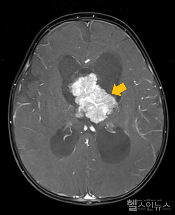 맥락얼기유두종뇌MRI
