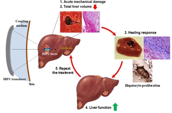 간경화치료히스토트립시개념도