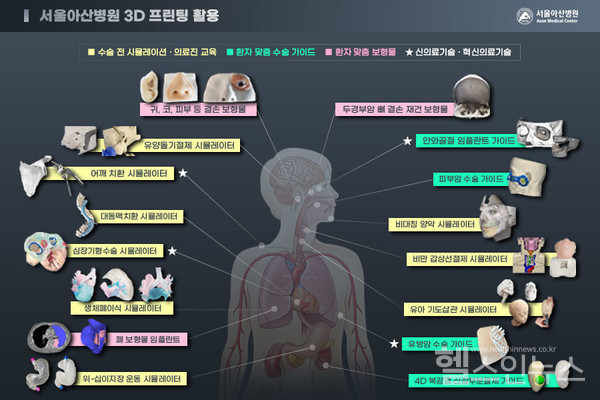 서울아산병원3D프린팅활용