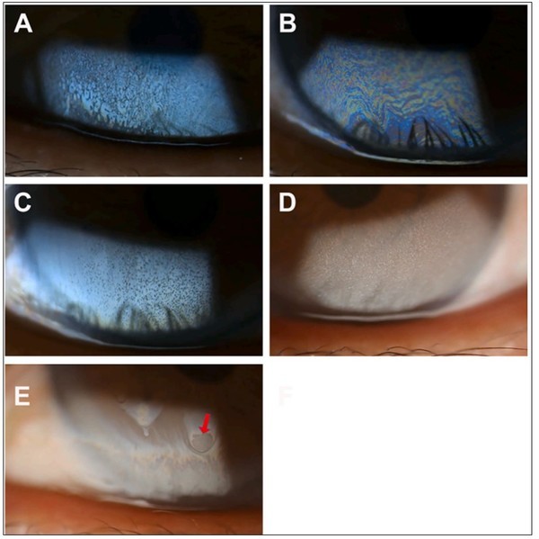 LED면광원과세극등현미경으로관찰한다양한화장품오염패턴.(A)마블링,(B)너무많은색상,(C)검은점,(D)흰점,(E)건조영역(빨간색화살표)
